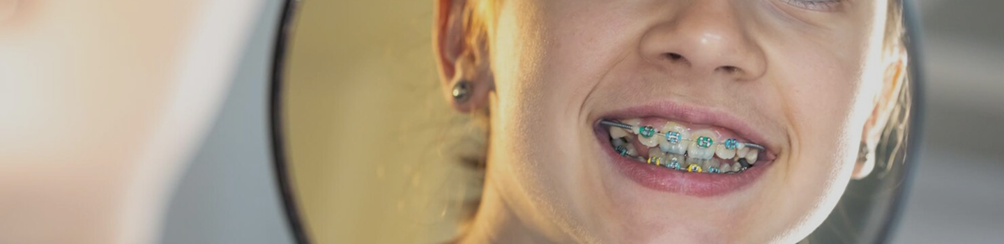 Braces FAQs