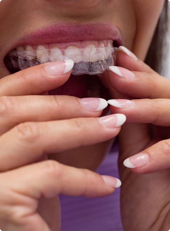 Clear ALigner
