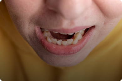 Posterior Crossbite