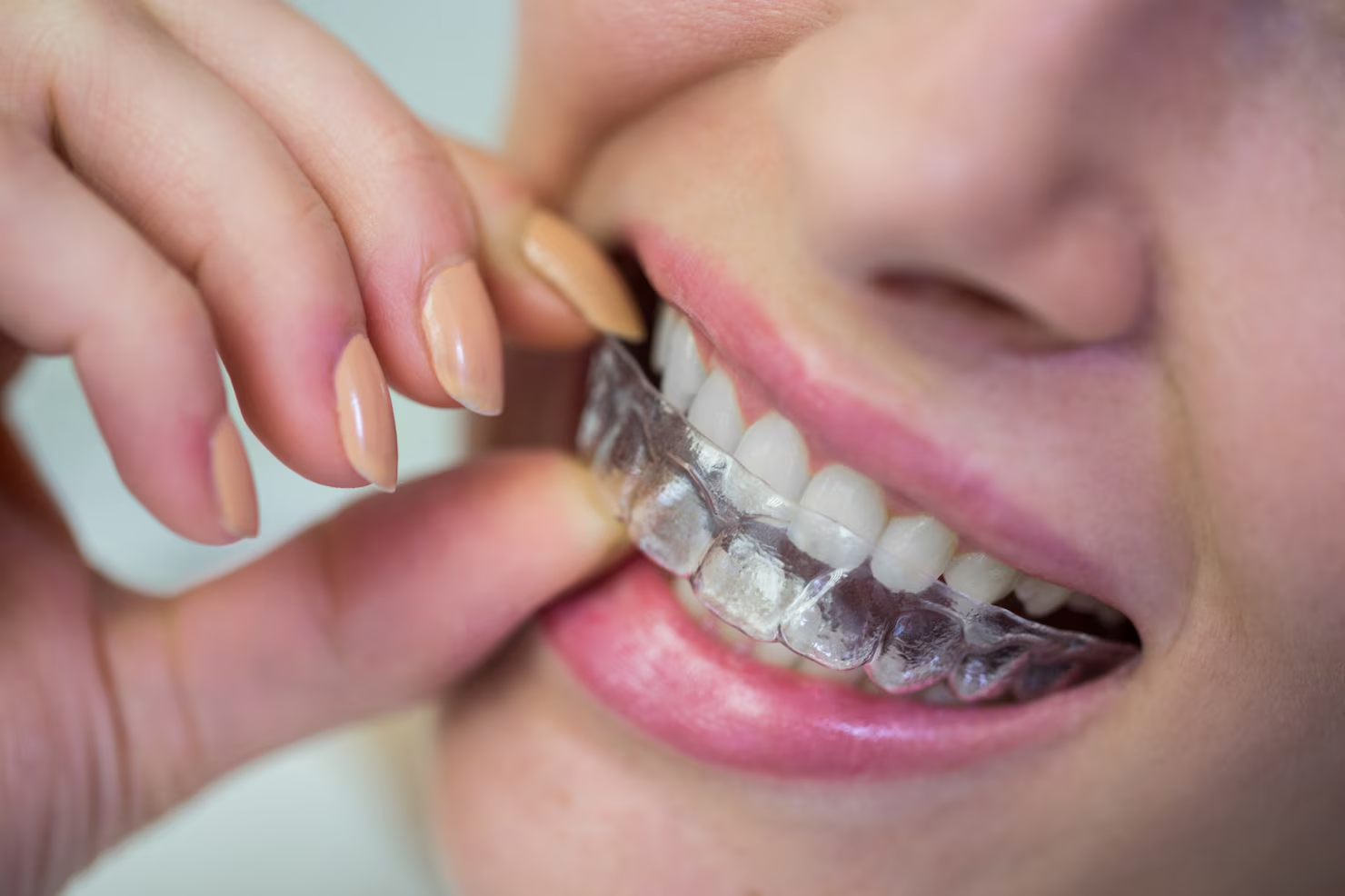Braces Adjustment