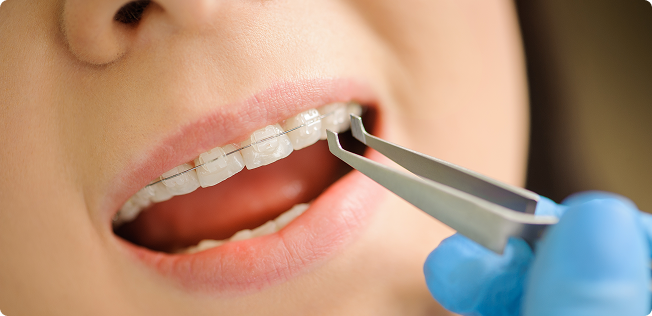 Ceramic Braces
