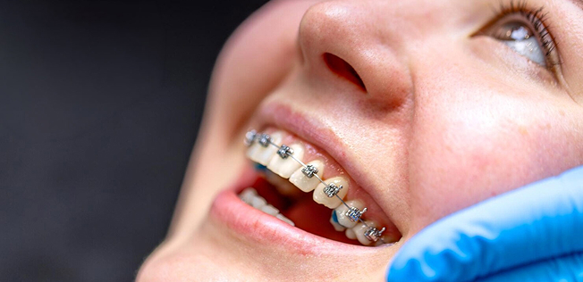 Metal Braces